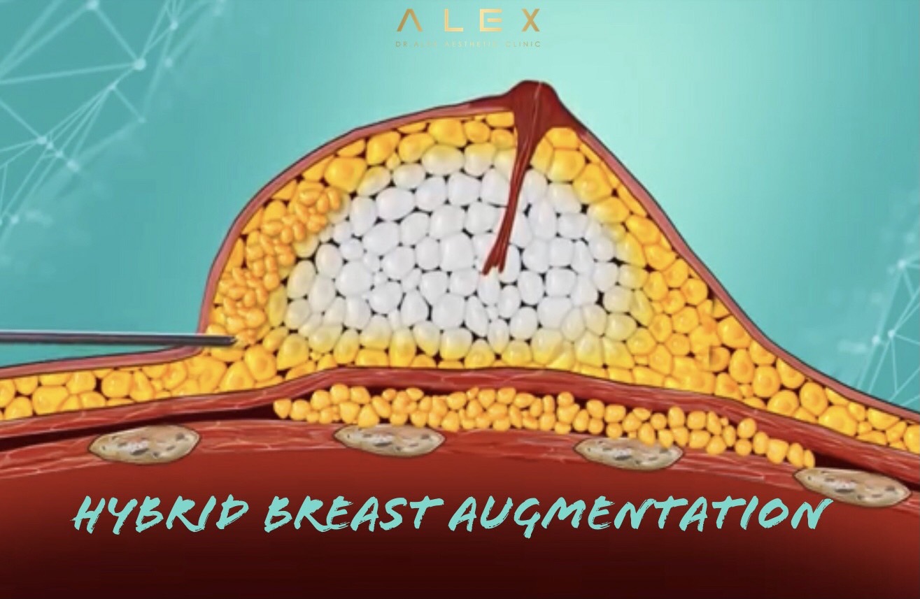 Breast Augmentation - DR.ALEX